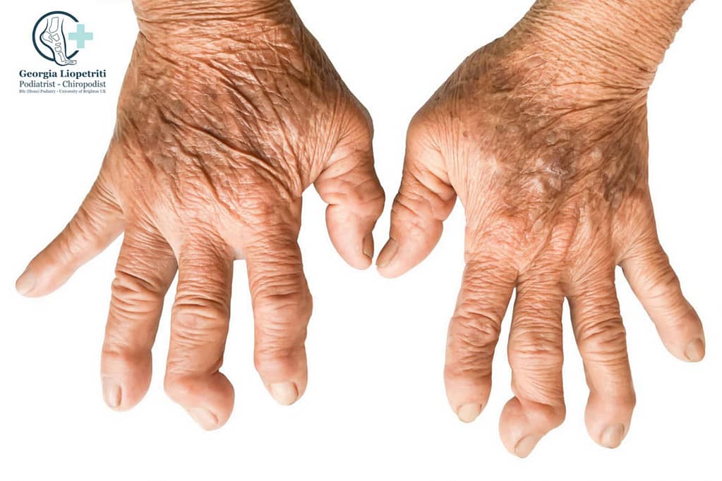 Paphos Podiatrist Rheumatoid Arthritis
