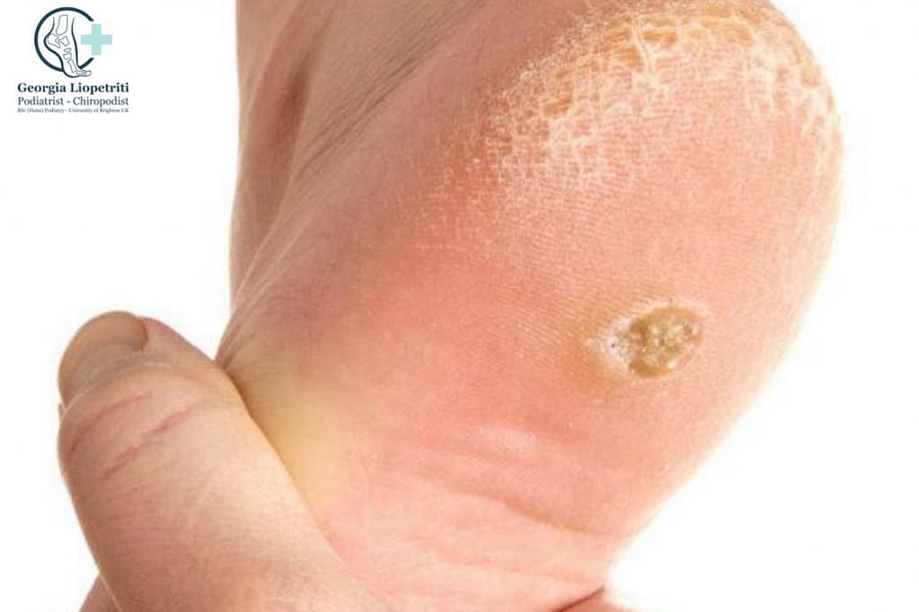 Paphos Podiatrist Corns and Callous