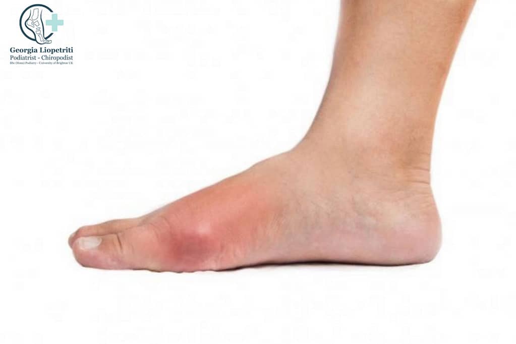 Paphos Podiatrist Gout