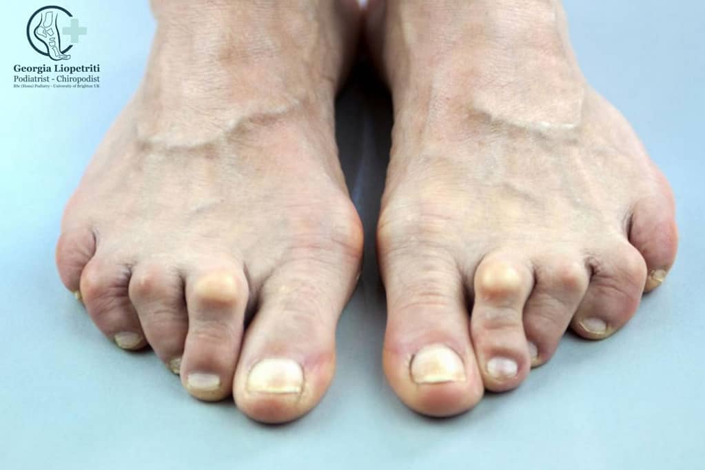Paphos Podiatrist Osteoarthritis