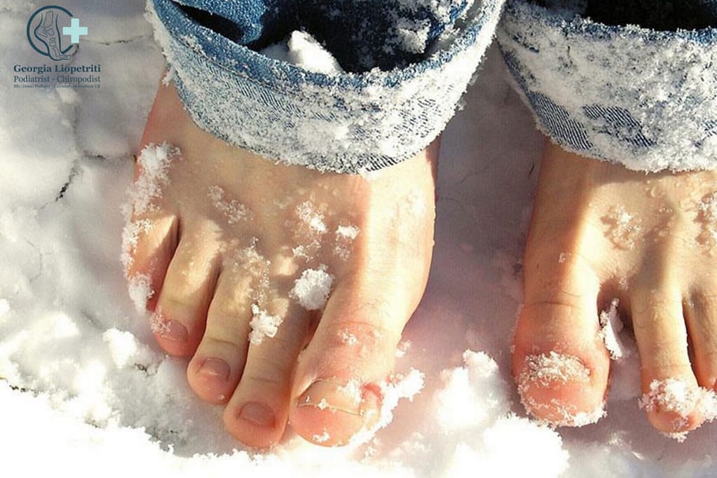 Paphos Podiatry Chilblains
