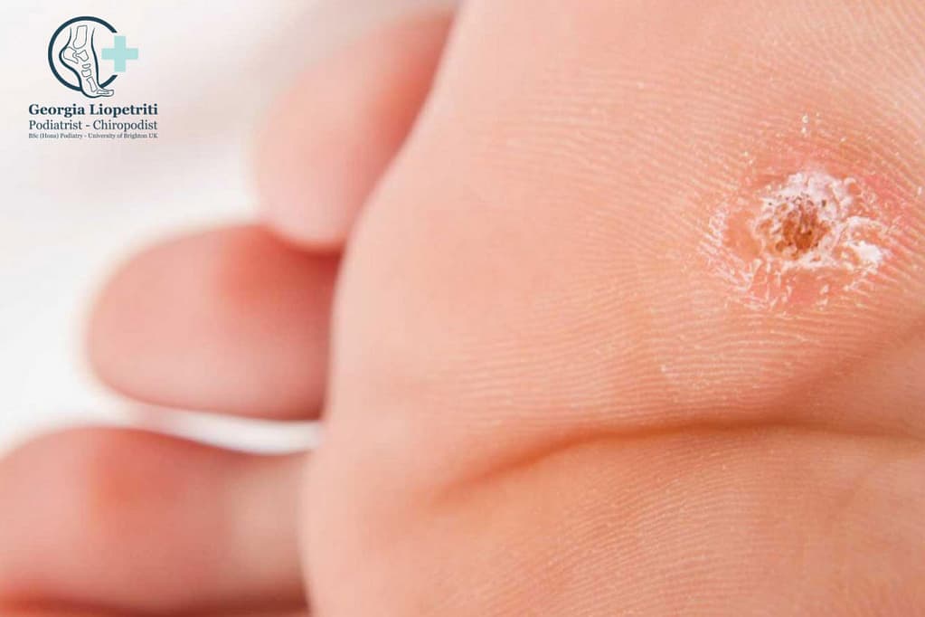 Paphos Podiatry Verrucae Treatment