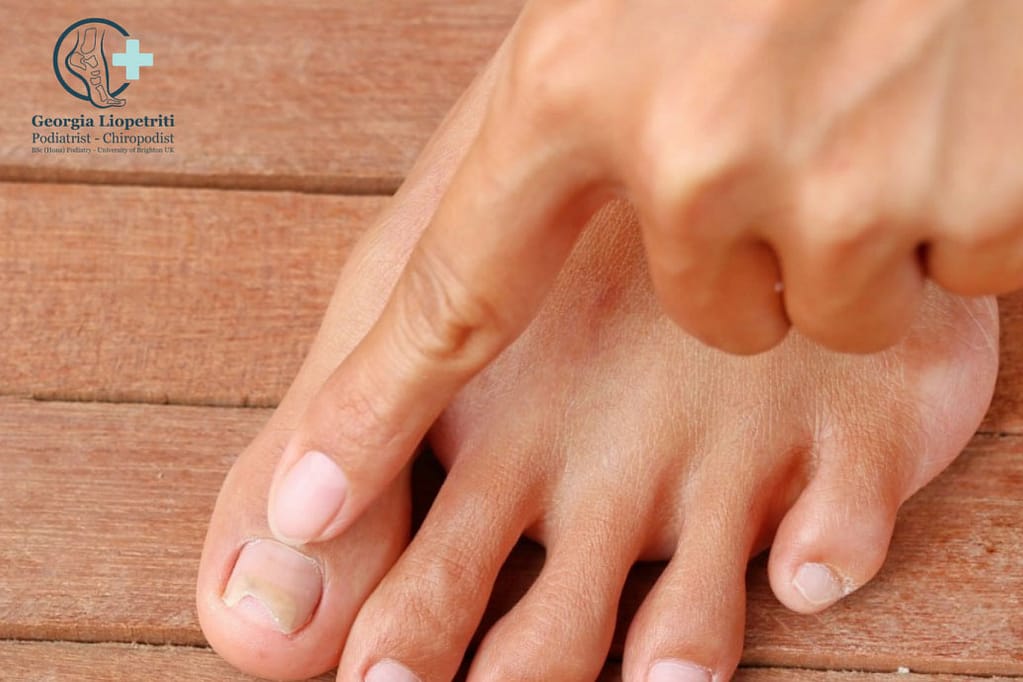 Paphos Podiatrist Onychomycosis fungal nails