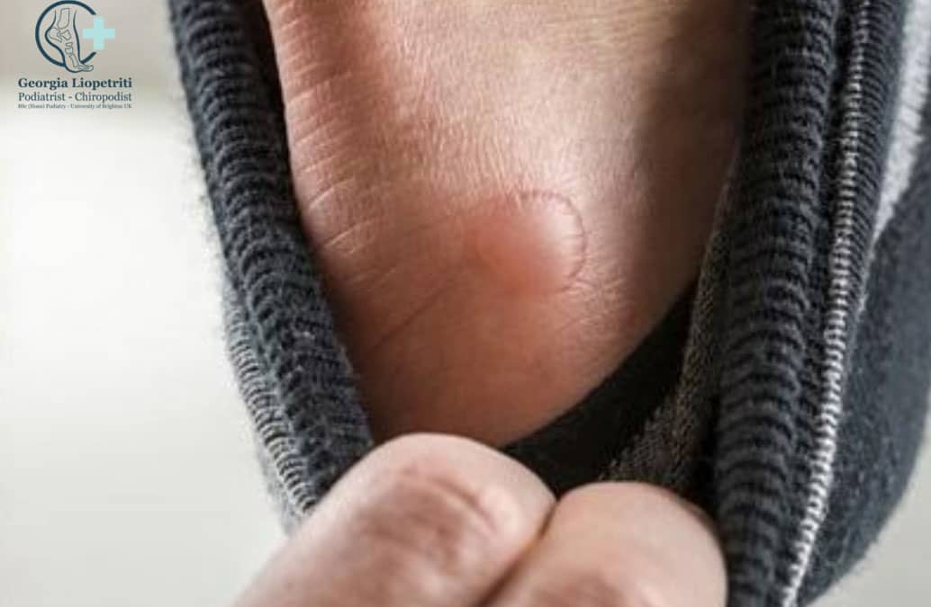 Blisters