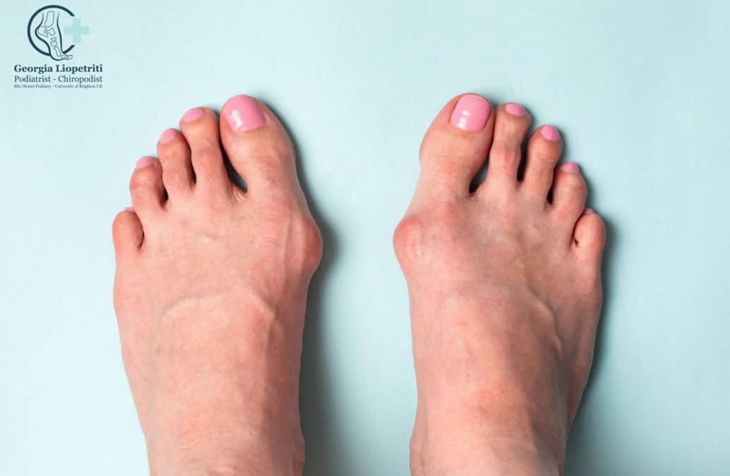 Bunions (Hallux Abductovalgus)