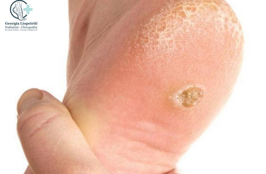 Corns & Callous