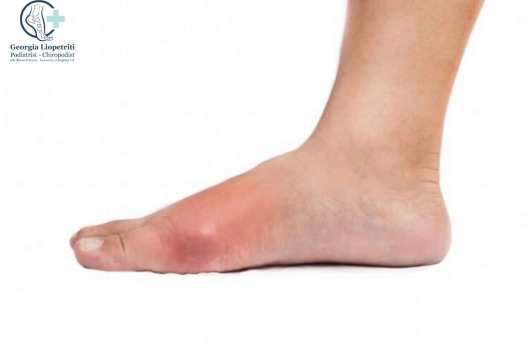 Gout