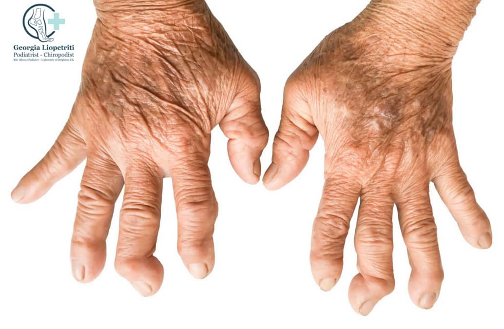 Rheumatoid Arthritis