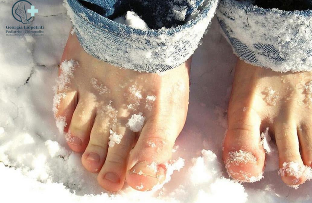 Chilblains