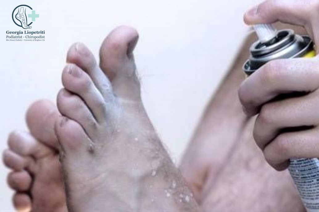 Paphos Podiatrist Athlete’s foot tinea pedis