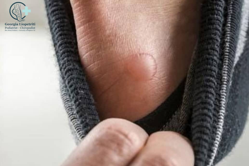 Paphos Podiatrist Blisters