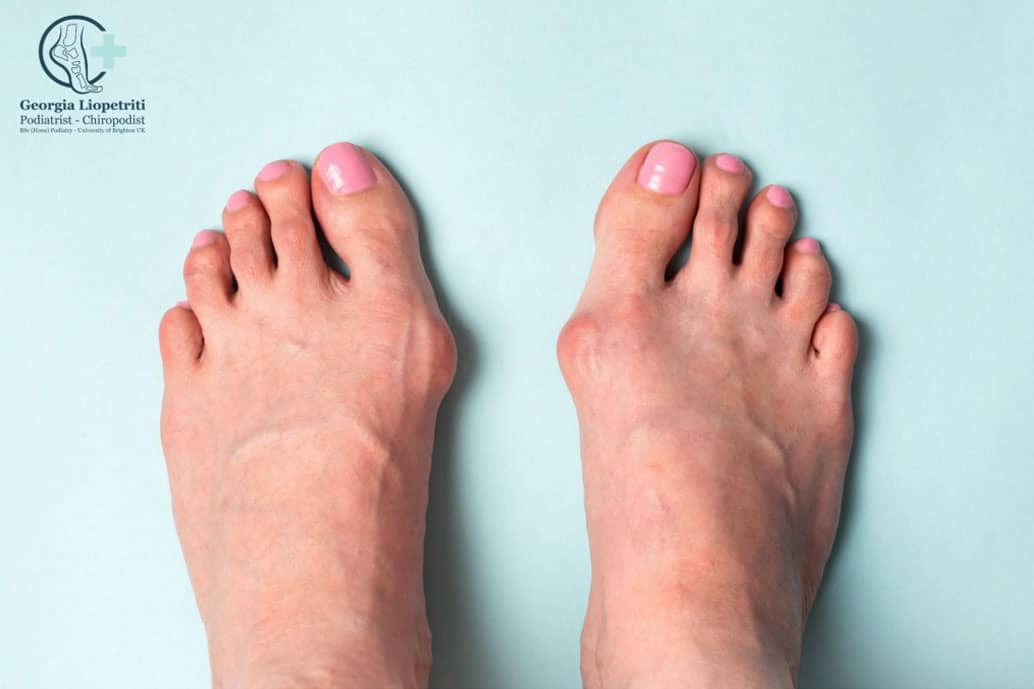 Paphos Podiatrist Bunions Hallux Abductovalgus