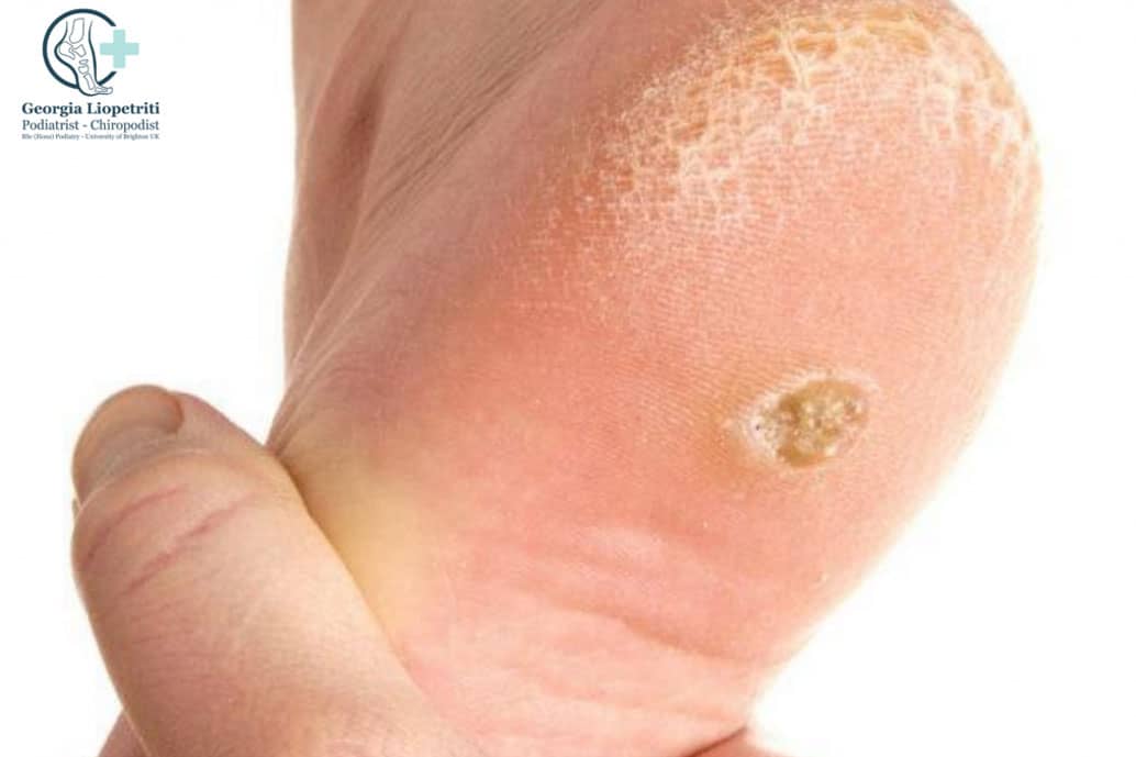 Paphos Podiatrist Corns and Callous Paphos Podiatrist Corns and Callous