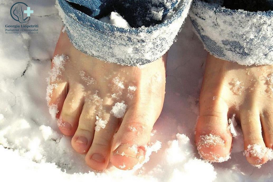 Paphos Podiatry Chilblains
