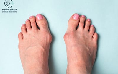 Bunions (Hallux Abductovalgus)