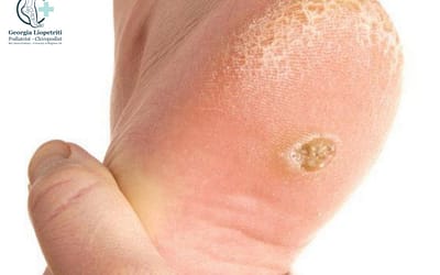Corns & Callous