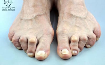 Osteoarthritis