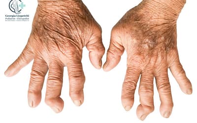 Rheumatoid Arthritis