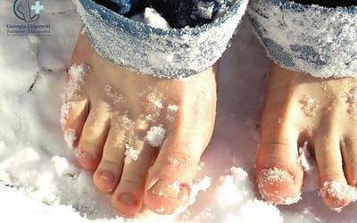 Chilblains